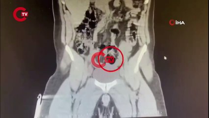 Kars'ta İranlı kuryenin makatından uyuşturucu çıktı