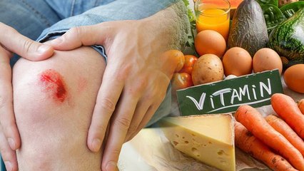 Vitamin Deficiency Cause Severe Injury: किस विटामिन की कमी से चोट से ज्यादा खून निकलता है...