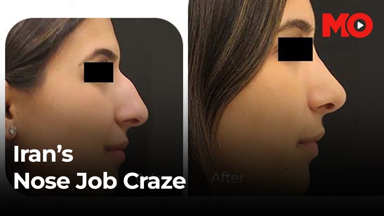 Iran’s nose job obsession