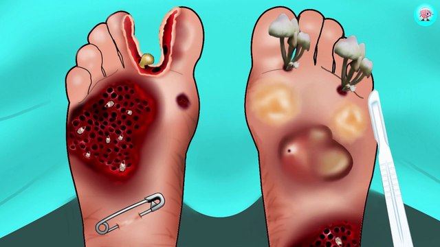 13. ASMR Treatment athletes foot and remove maggot between toes Foot care animation Braini ASMR