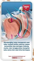 Sering Mengorok Saat Tidur, Ternyata Ini Risikonya Bagi Kesehatan