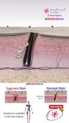 Ingrown Hair ⨖ Laser Treatment ⨕ Medical Arts 3D Animation