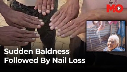Buldhana’s medical mystery: From hair loss to falling nails