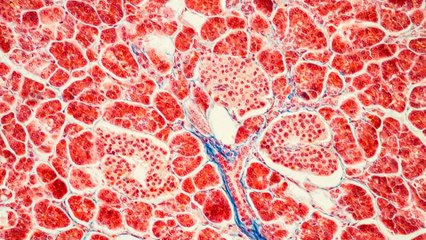 Preocupa el aumento de los diagnósticos en cáncer de páncreas, uno de los más mortíferos