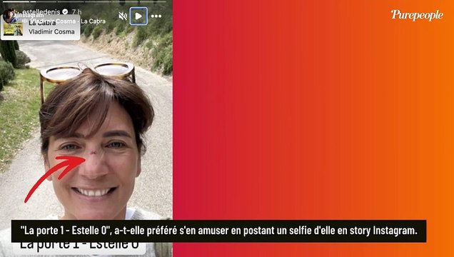 Estelle Denis amochée au visage après un incident survenu pendant ses vacances avec son compagnon Marc Thiercelin
