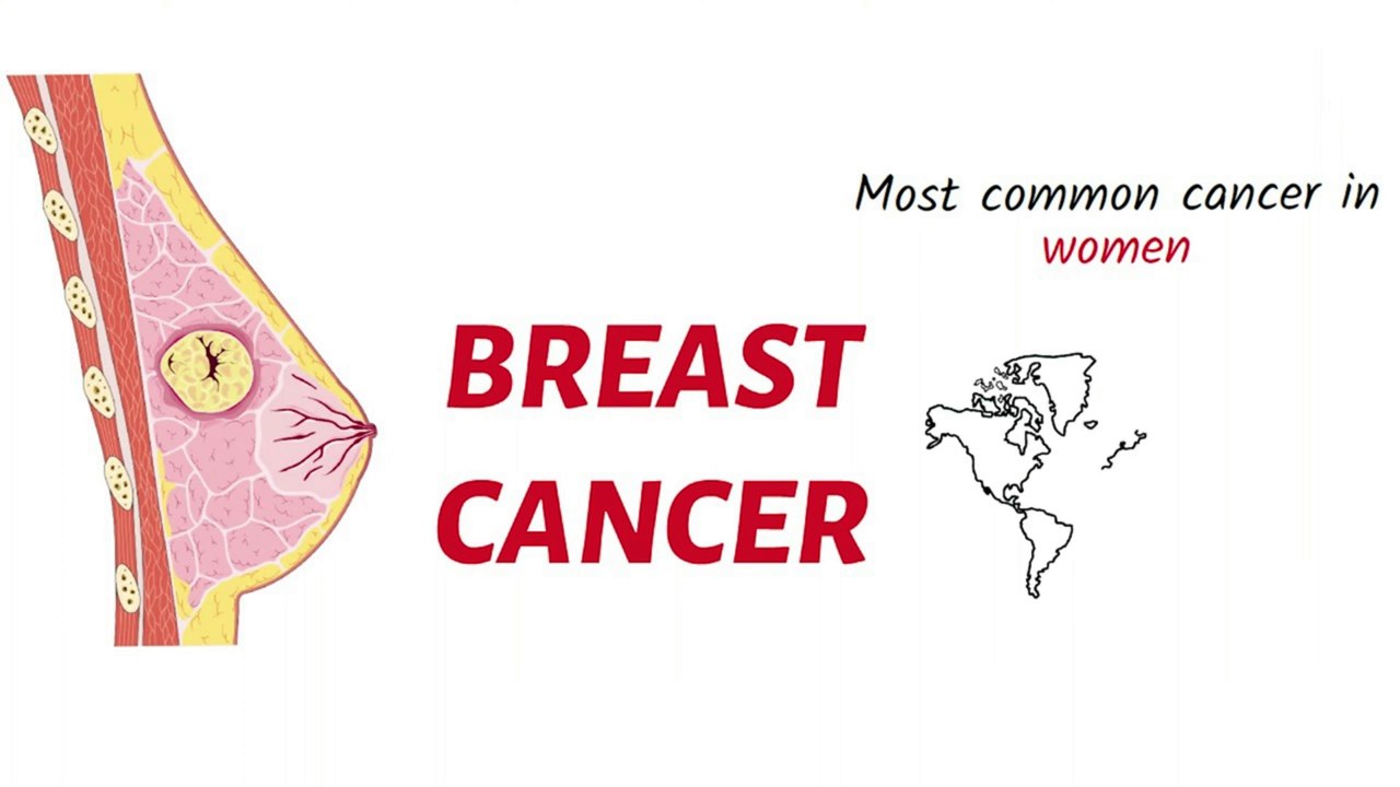 Breast Cancer  Causes, Symptoms, Types, and Treatment Explained