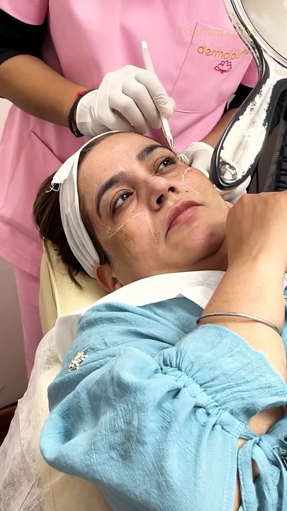 Tired of spending time and money on waxing, threading, or shaving every few days Face laser gives you long-lasting smooth skin, no ingrown hairs, and zero razor burns—just freedom from the constant cycle.To bo