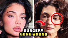 Kylie Jenner's Face Is Concerning To Her Fans