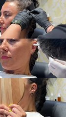 Helix on Point: Dr. Vikas Nailed This Forward Thriller #forwardhelix #helixpiercing #earpiercing