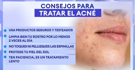 Consejos para tratar el acné