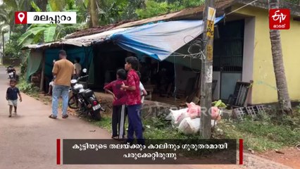 വാക്‌സിന്‍ എടുത്തിട്ടും പേവിഷബാധ; അഞ്ച് വയസുകാരി ഗുരുതരാവസ്ഥയില്‍