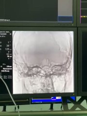 Hemodinâmica de Patos realiza procedimento inédito e contribui para doação de órgãos no Sertão