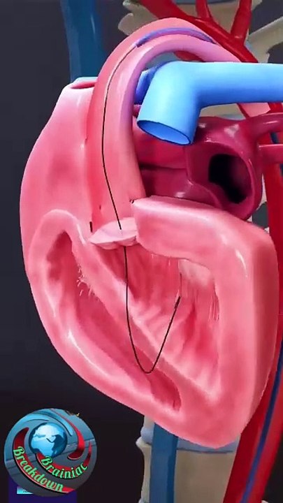Angeoplasty