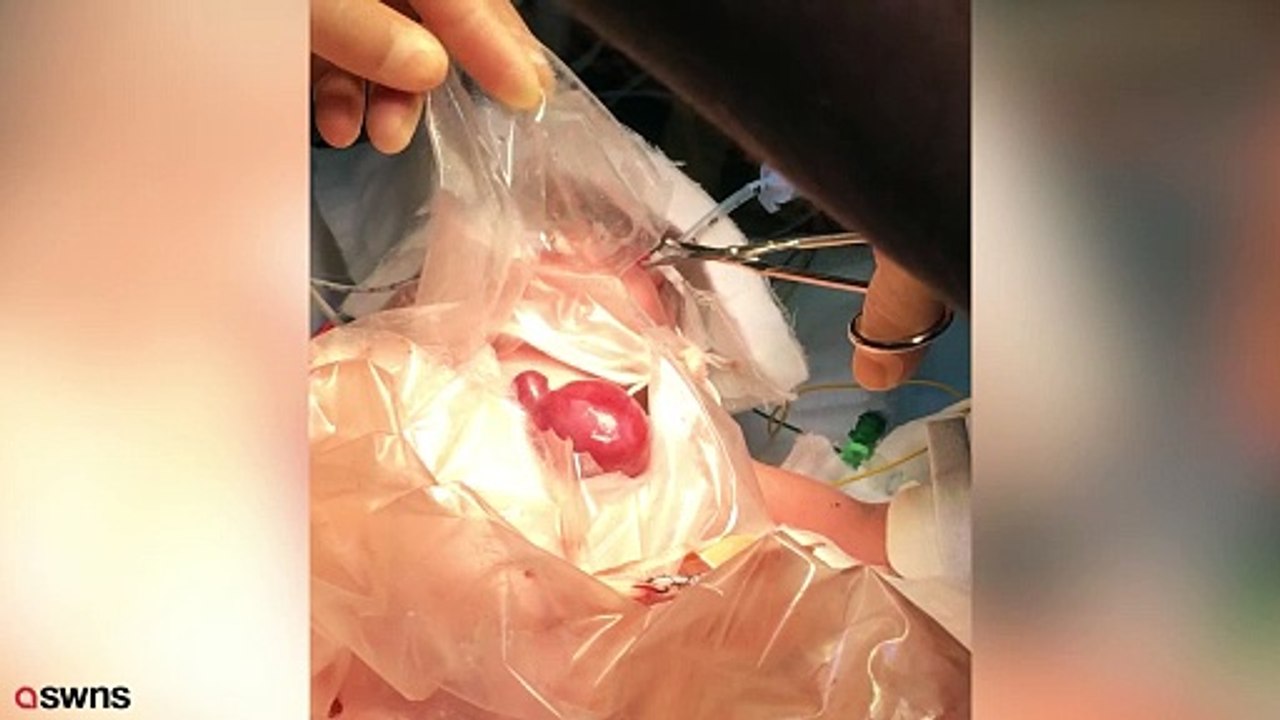 Girl born with heart outside body undergoes UK-first operation