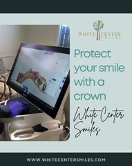 Protect Your Smile with a Perfectly Fitted Dental Crown in Seattle