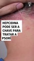 Hepcidina pode ser a chave para tratar a psoríase