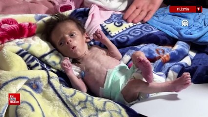 Gazze'de çocuklar yetersiz beslenme ile mücadele ediyor