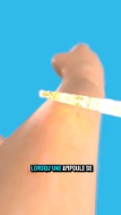 Un ampoule se formé