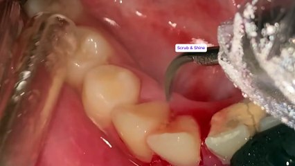 Can You Watch Till the End? Top 3 Most Shocking Tartar Removals!