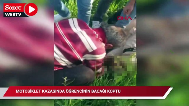 Trafik levhasına çarpan motosikletteki üniversite öğrencisinin bacağı koptu