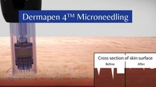 Reveal Radiant, Glass-Like Skin with Meso-Tox Treatment