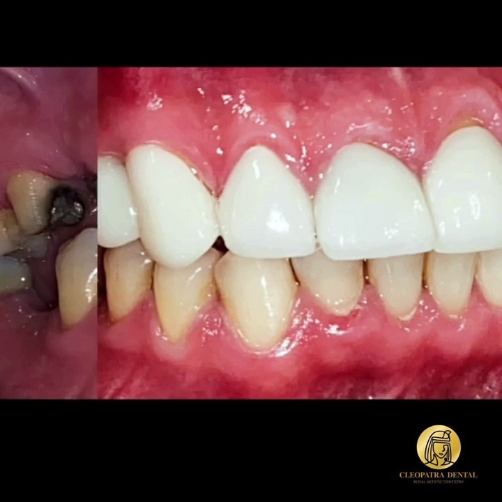 Bring Back Your Natural Smile with Dental Implants & Crowns in Yorba Linda, CA