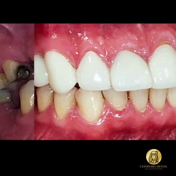 Bring Back Your Natural Smile with Dental Implants & Crowns in Yorba Linda, CA