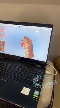 ou can be camera-ready with Invisalign clear aligners and smile with confidence!