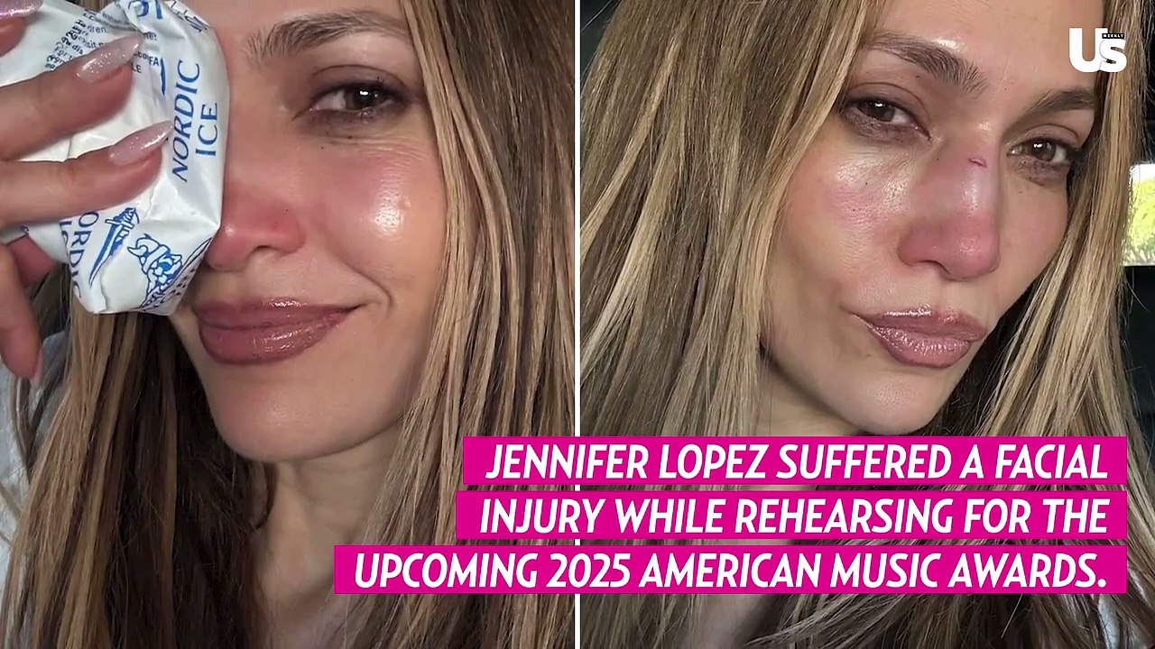 Jennifer Lopez Shares Photos of Severe Facial Injury From AMAs Rehearsals