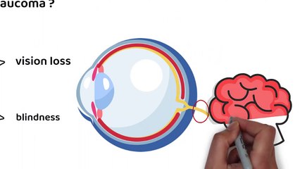What is GLAUCOMA_ (Symptoms, Causes, Treatment, Prevention)