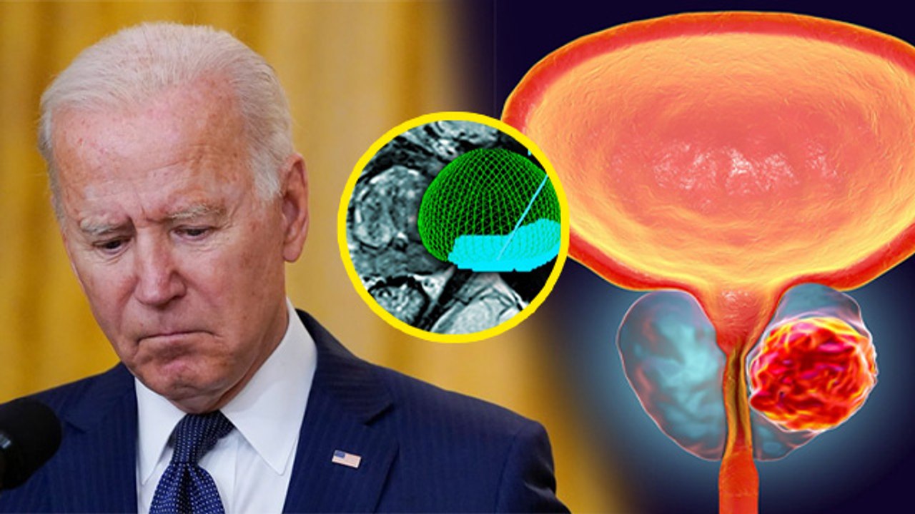 Joe Biden Aggressive Prostate Cancer:आक्रामक प्रोस्टेट कैंसर क्या  है,Causes,Symptoms & Treatment...