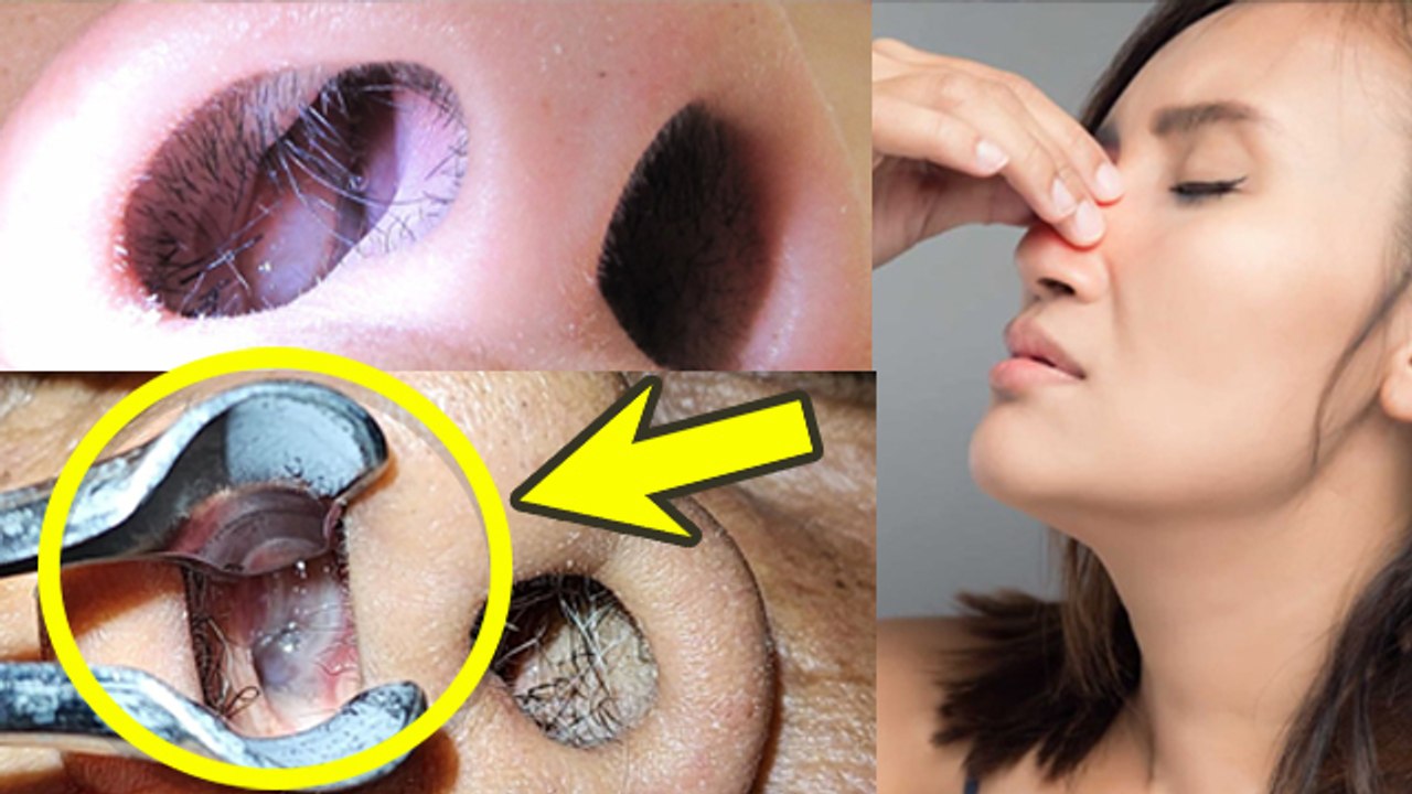 Nasal Polyps Causes: नाक के पॉलीप्स क्या है, Symptoms & Treatment | Boldsky