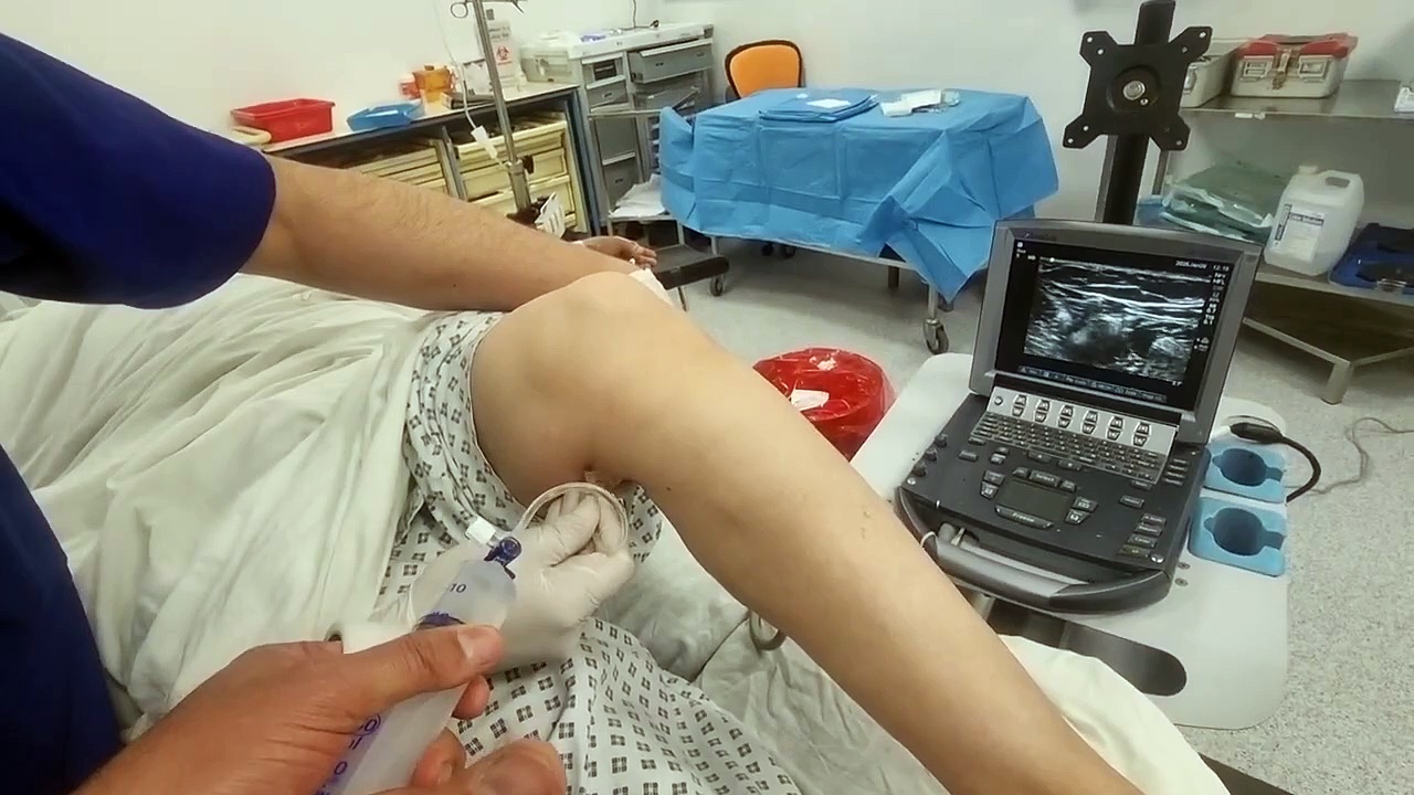Femoral nerve block + popliteal nerve block in heart diseases