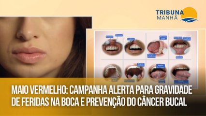 Maio Vermelho: Campanha alerta para gravidade de feridas na boca e prevenção do câncer bucal