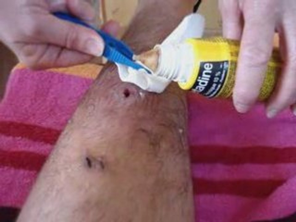 Infection Tibia