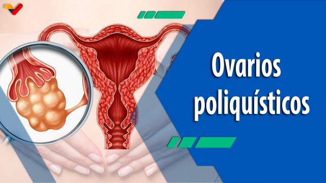 Actitud Saludable | Salud femenina: Síndrome de ovarios poliquísticos y sus características