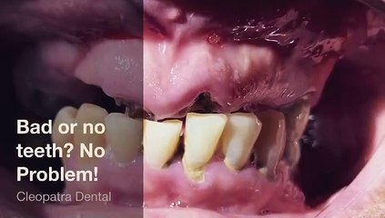 Bad Teeth to Beautiful Smiles – Watch What’s Possible | Cleopatra Dental Huntington Beach