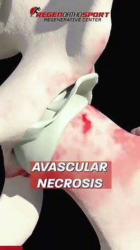 Stem Cell Therapy for Shoulder Rotator Cuff & Labral Tear Repair