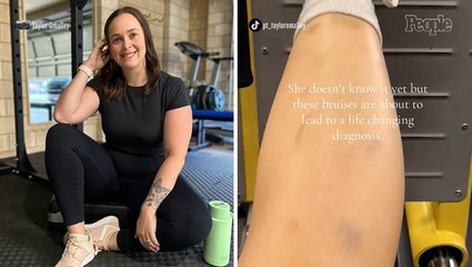 She Thought the Bruises Were Random. Then a Diagnosis Changed Everything (Exclusive)