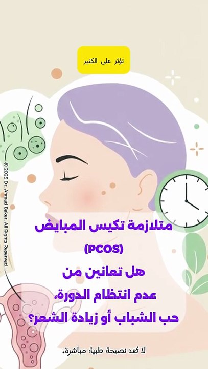 متلازمة تكيس المبايض (PCOS): كل ما تحتاجين معرفته عن الأعراض والتشخيص