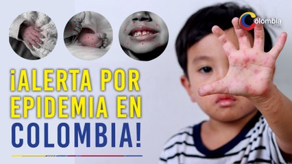 Contagio masivo del síndrome boca-mano-pie en Colombia: todo lo que debes saber para prevenirlo