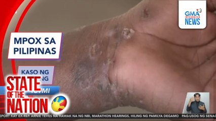 In Case You Missed It: MPOX sa Pilipinas; Kaso ng ketong; Bantay-taal | SONA
