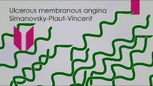 Treatment of ulcerous membranous angina Simanovsky-Plaut-Vincent