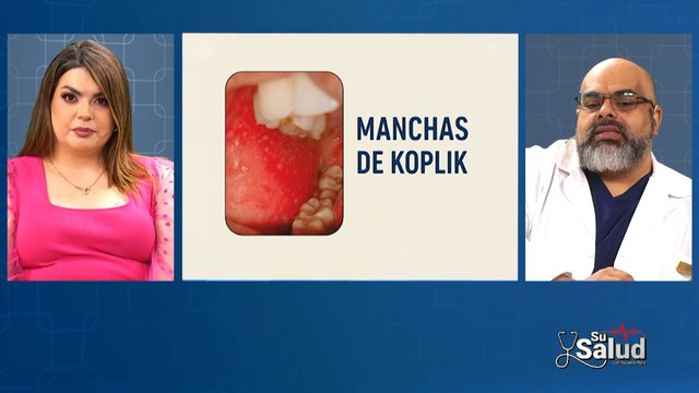 Su Salud: Síntomas que diferencian al sarampión de otras enfermedades