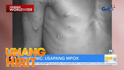 UH Clinic— Face mask, walang tulong kontra-MPOX | Unang Hirit