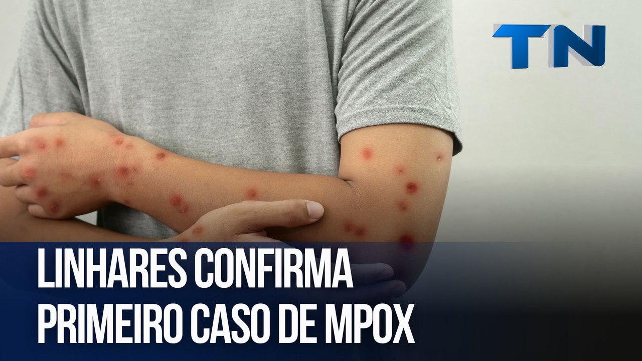 Linhares confirma primeiro caso de Mpox