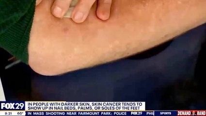 Watch: Moment shocked news anchor is diagnosed with skin cancer live on-air