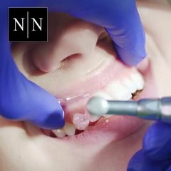 Transform Your Smile Through the Teeth Whitening Process