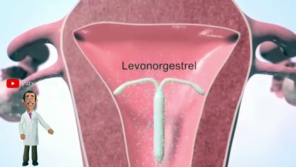 ప్రెగ్నెన్సీ వద్దనుకుంటున్నారా? 👌👌 | Besy way to avoid pregnancy | Copper T | #viral #trending