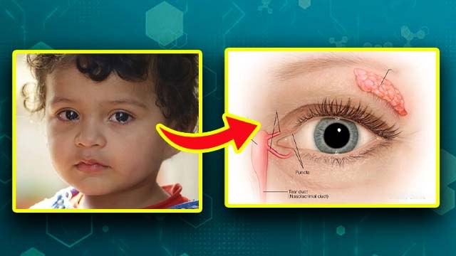 Newborn Watery Eyes: बच्चों की आंख से पानी आना कैसे ठीक करें, Treatment At Home...
